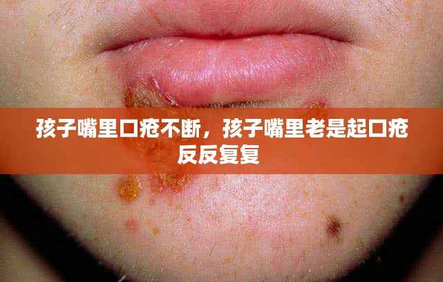 孩子嘴里口疮不断，孩子嘴里老是起口疮反反复复 