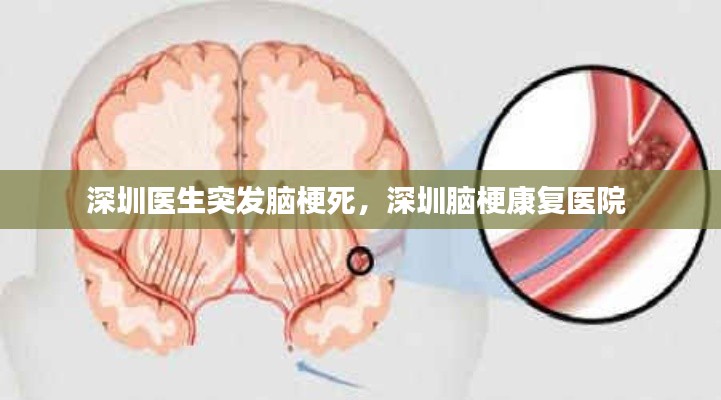深圳医生突发脑梗死,深圳脑梗康复医院